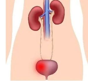 Causes of cystitis in women