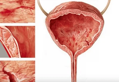Causes of cystitis in women